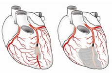 Illustration of coronary collaterals